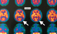 HBOT Showed Improvement In Alzheimer'S Disease